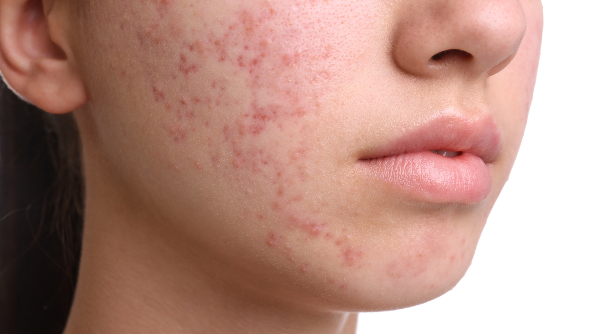 Achieve Glowing Skin: Exploring the Link Between Acne and Gut Health
